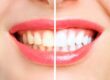 blanqueamiento dental barakaldo