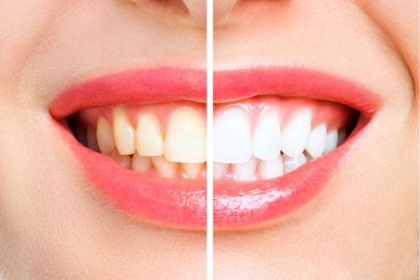 blanqueamiento dental barakaldo